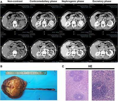 Misdiagnosis of renal pelvic unicentric Castleman disease: a case report